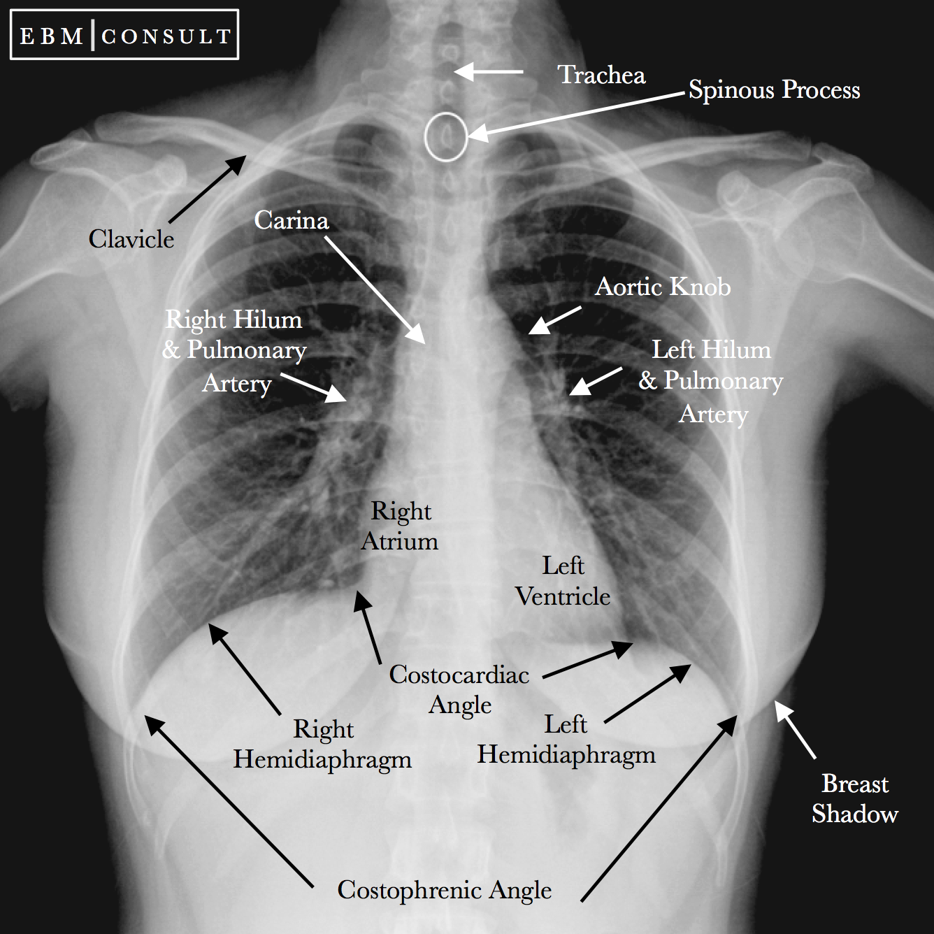 Radiology Chest Xray Normal
