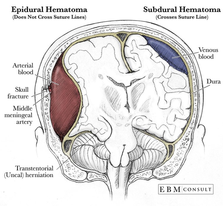 subdural hematoma bridging veins