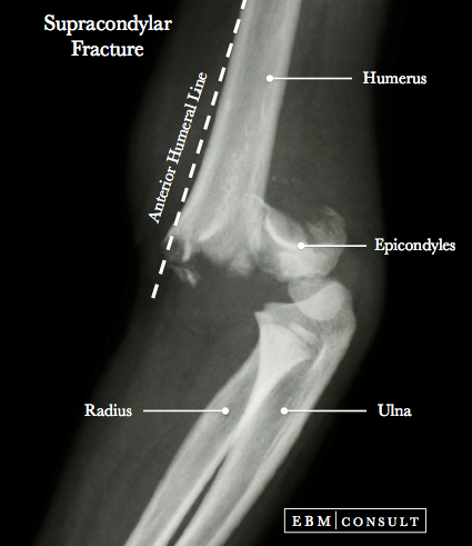 supracondylar humerus fracture