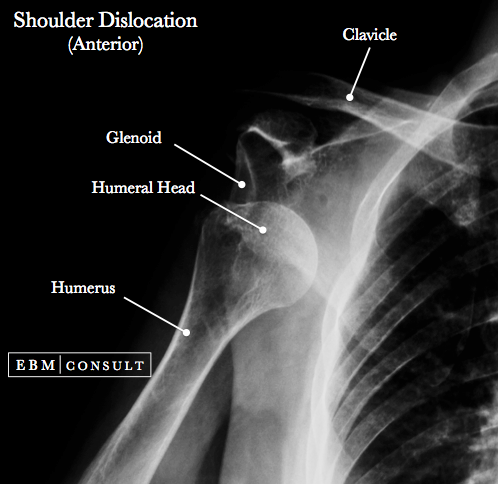 Anterior Shoulder Dislocation - General Review