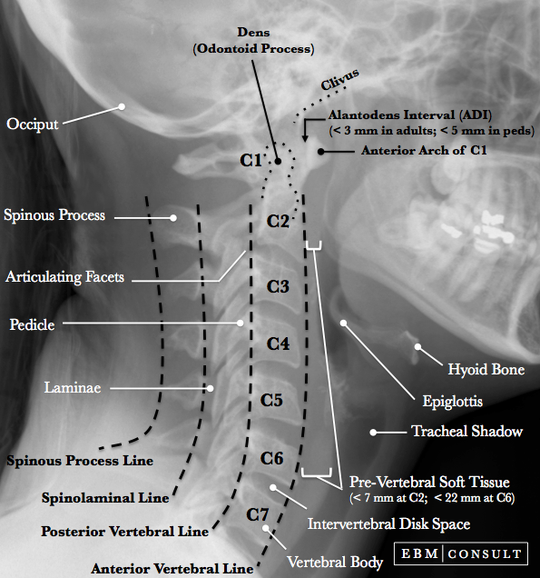 mechanism of injury in odontoid fracture